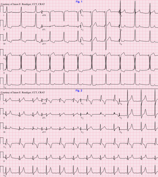 Wolff-Parkinson-White Pattern | ECG Guru - Instructor Resources